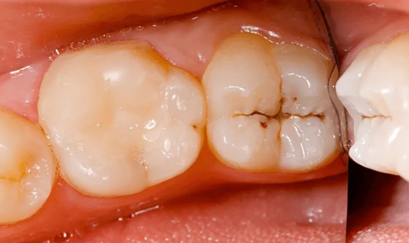Tình trạng sâu răng hàm