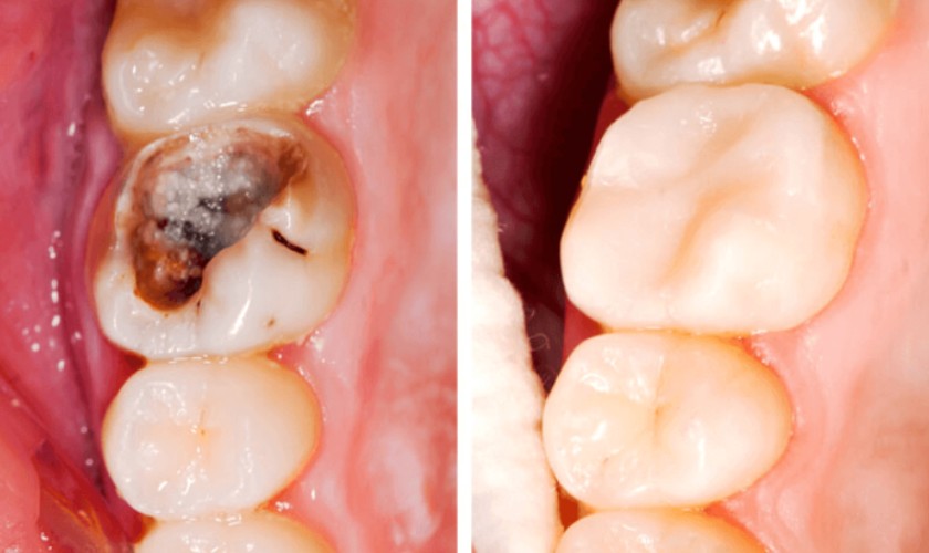 Trám răng hàm bị sâu