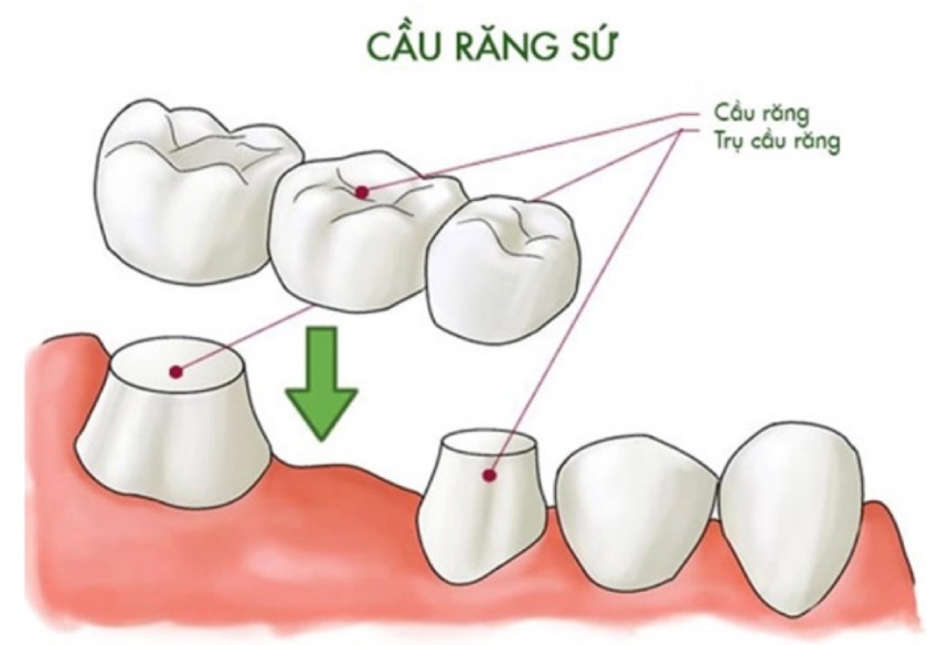 Cầu răng sứ cho răng hàm