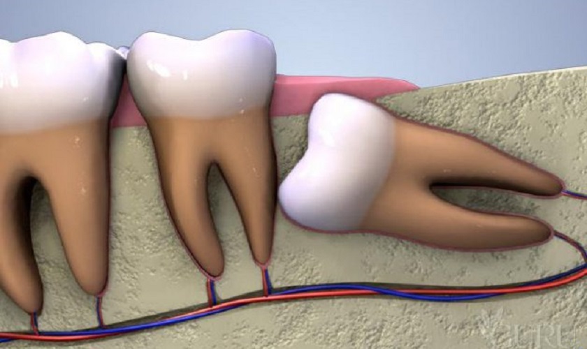 Răng số 8 mọc ngầm
