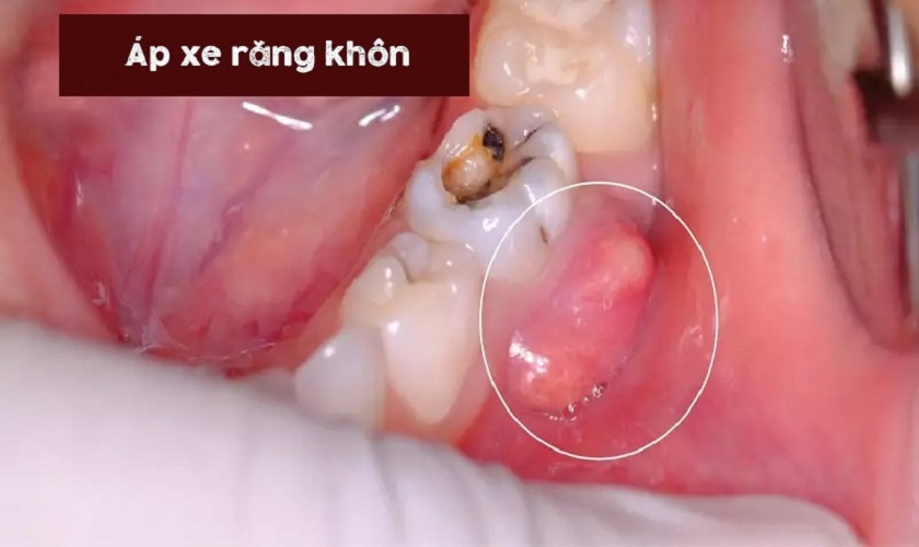 Áp xe răng khôn