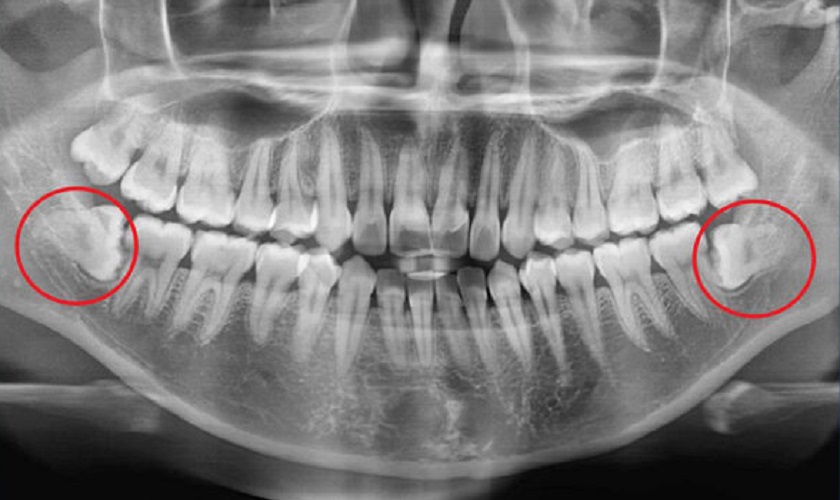 Phim chụp X – quang giúp bác sĩ chẩn đoán tình trạng và hướng mọc răng