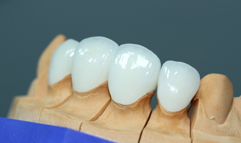 Răng sứ Emax Press