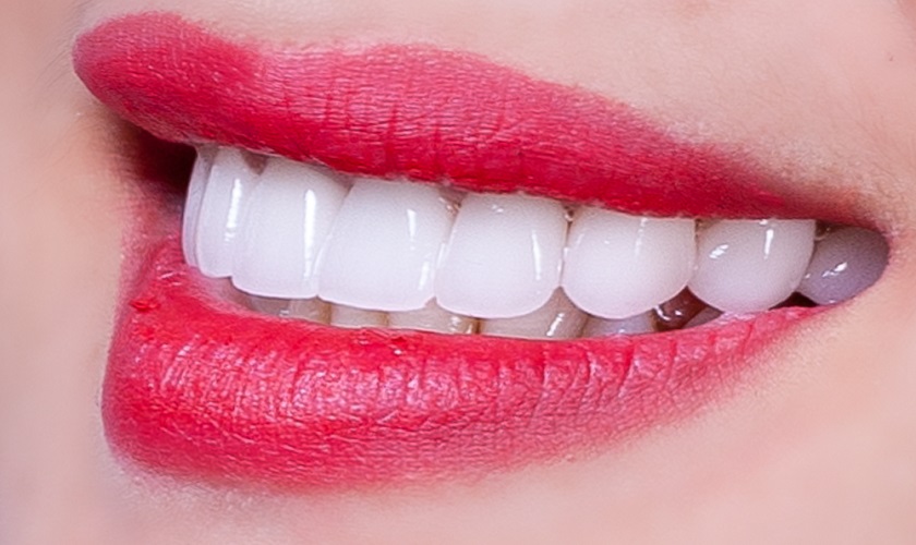 Răng sứ Emax được các bác sĩ nha khoa khuyên dùng nhờ nhiều ưu điểm vượt trội