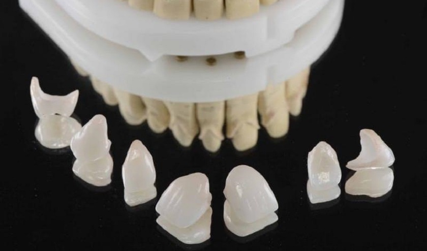 Răng sứ Emax phù hợp với nhiều trường hợp phục hình răng