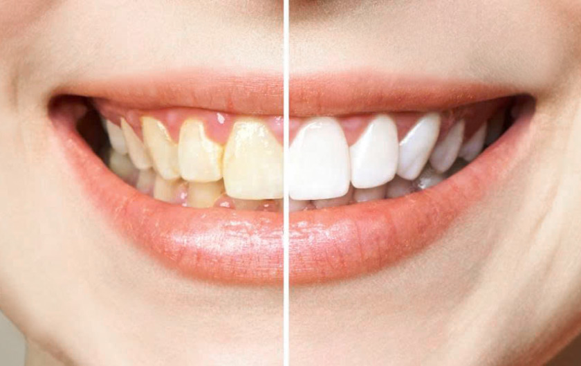 Răng sứ thẩm mỹ cải thiện răng xỉn màu