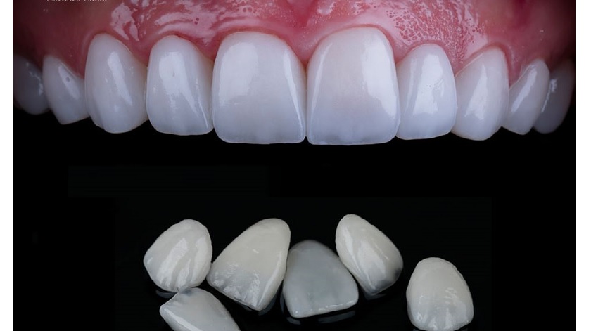 Ưu điểm của dán răng sứ veneer