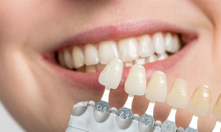 Răng sứ có bền không? Cách để kéo dài tuổi thọ răng sứ