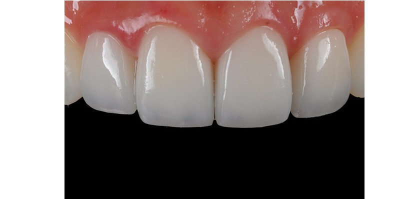 Quy trình bọc răng sứ đúng chuẩn