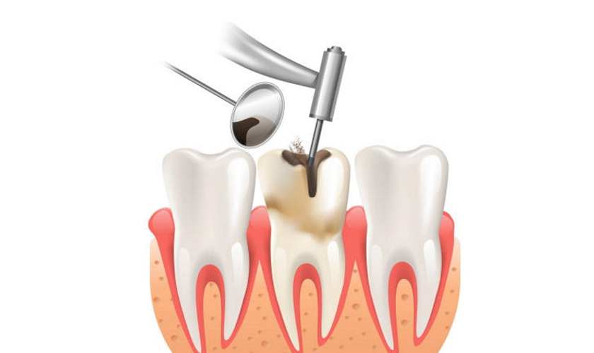 Bọc răng sứ có cần lấy tuỷ không?