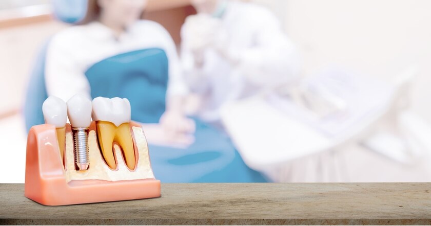 Trồng răng Implant