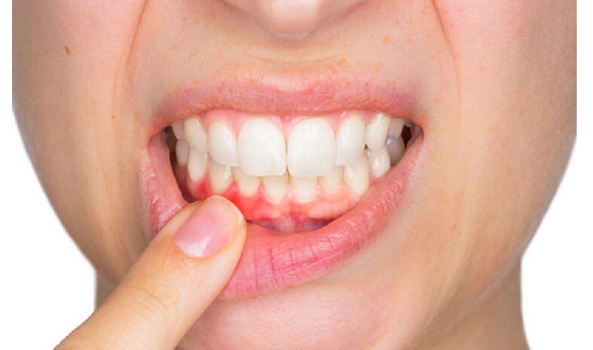 Viêm nướu sau bọc sứ có thể ảnh hưởng đến các răng khác