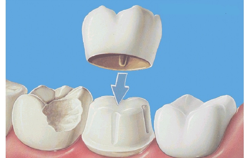 Mão răng sứ nếu không được gắn đúng chuẩn sẽ tạo điều kiện để vi khuẩn phát triển