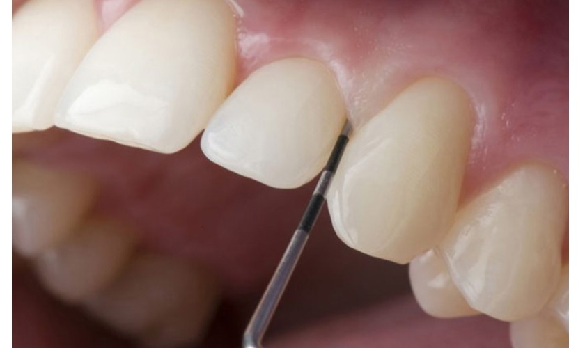 Nếu răng sứ bị cộm do mài răng sứ không chính xác, bạn sẽ phải tiến hành bọc sứ lại từ đầu