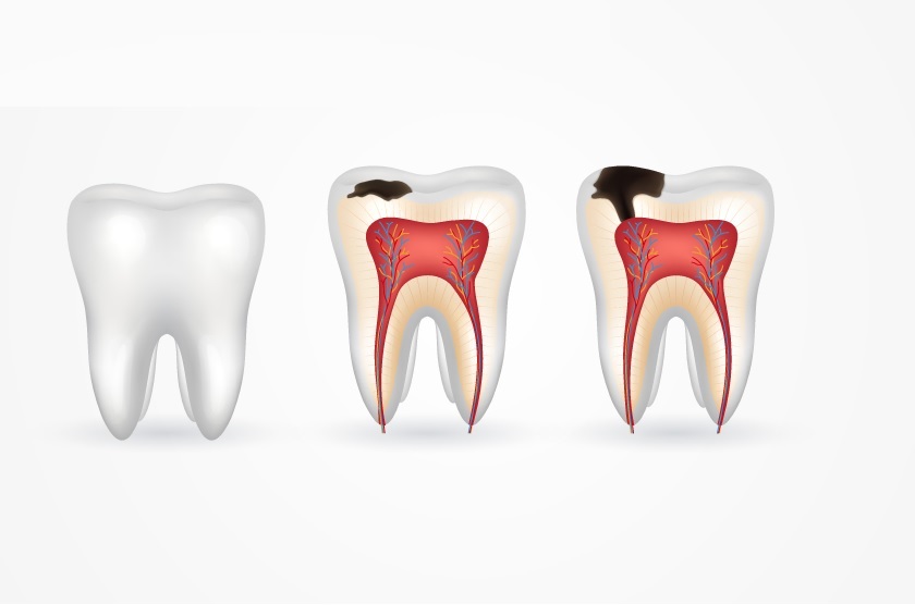 Răng sứ giá rẻ có thể gây ra hôi miệng, sâu răng, viêm nha chu,...