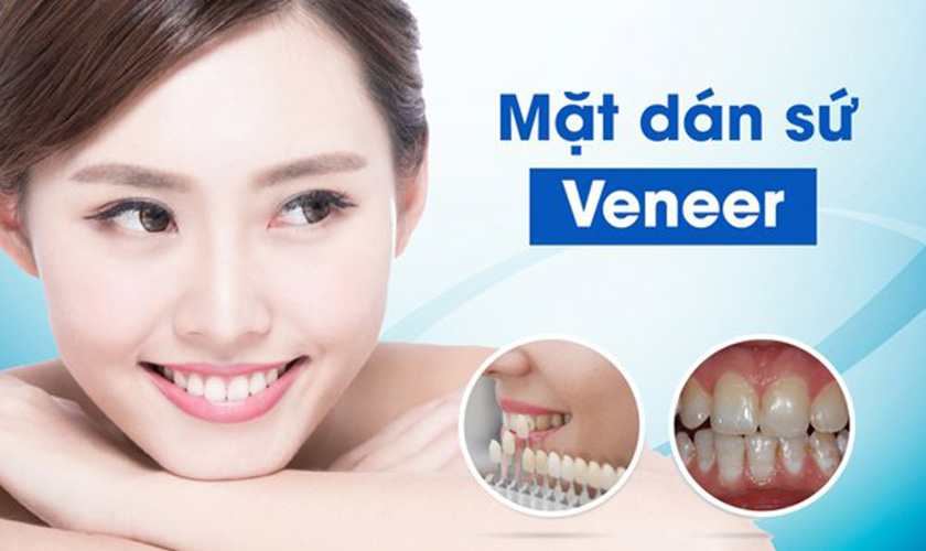 Dán sứ Veneer khắc phục tình trạng răng nhiễm Fluor