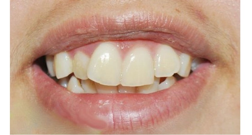 Răng cửa lớn sẽ gây mất tự tin trong quá trình giao tiếp