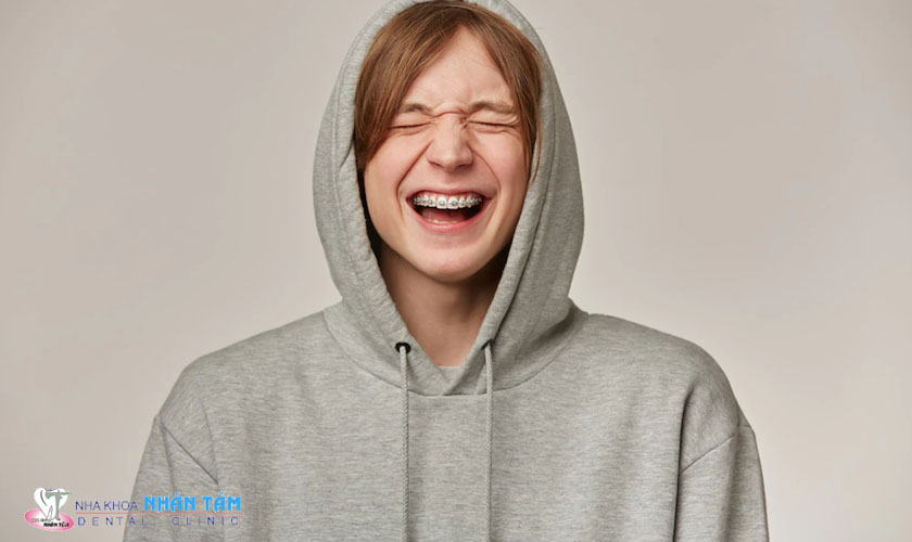 Niềng răng chỉnh nha giúp khắc phục tình trạng răng cửa to và giúp bạn sở hữu hàm răng đều đẹp, cân đối