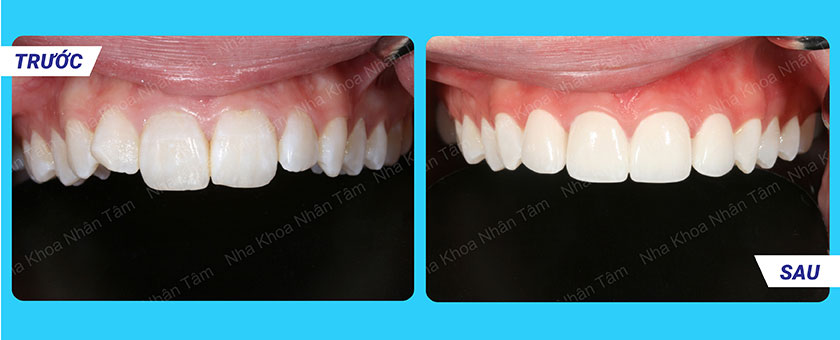 Nha khoa Nhân Tâm - địa chỉ phục hình răng đảm bảo bền đẹp