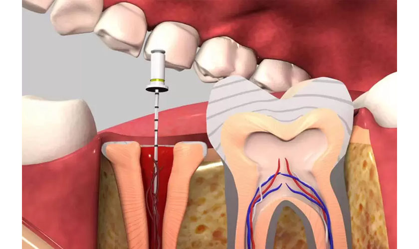 Vì sao cần tiến hành bọc răng sứ sau khi lấy tuỷ?