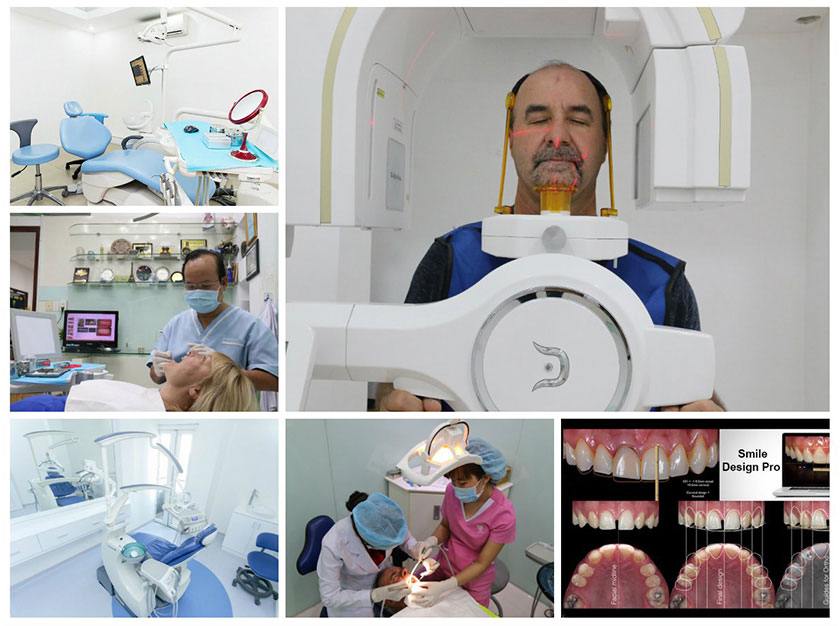 Răng sứ titan có khá nhiều ưu điểm nổi bật