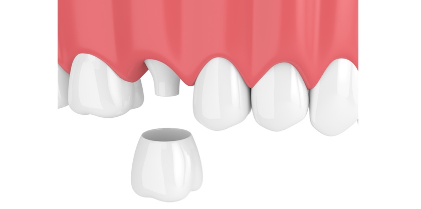 Bọc sứ 1 chiếc răng được không?