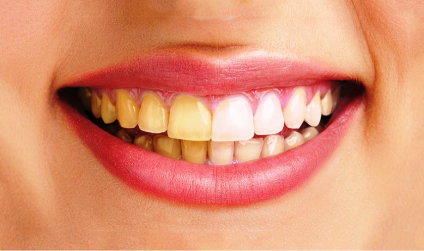 Kích thước của răng sứ cần phù hợp với răng thật