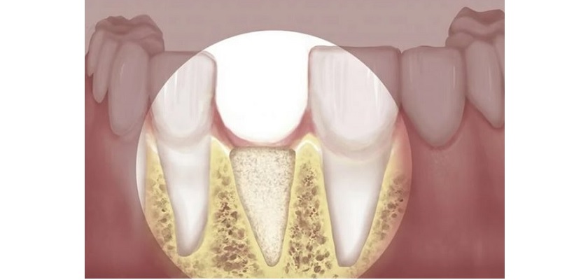 Răng bị tiêu xương ổ răng Răng bị tiêu xương ổ răng