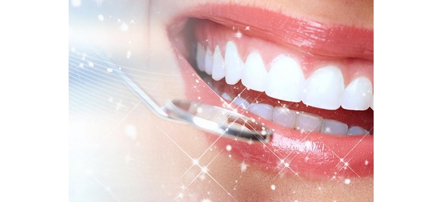 Răng sứ có thể tồn tại 10-20 năm tuỳ vào cách chăm sóc răng miệng sau phục hình Răng sứ có thể tồn tại 10-20 năm tuỳ vào cách chăm sóc răng miệng sau phục hình