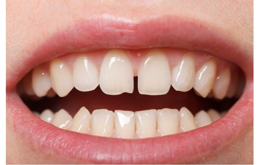 Những trường hợp được chỉ định phục hình răng sứ