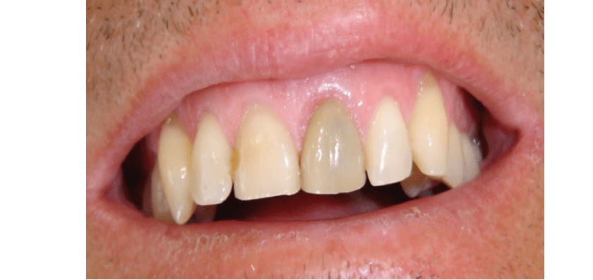 Răng bị chết tuỷ