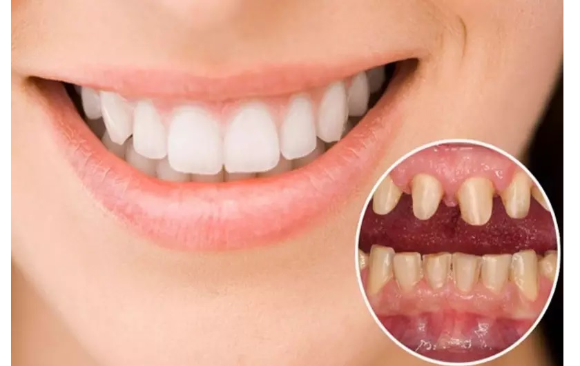 Răng sứ giúp bảo vệ răng thật bên trong