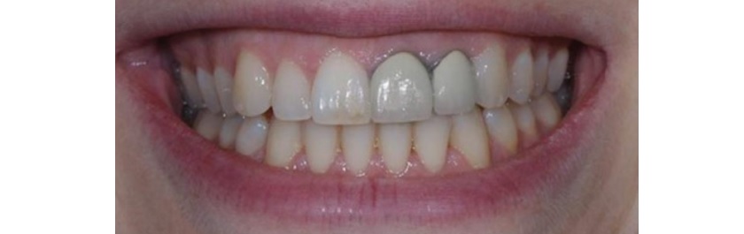 Răng bị đen chân do sử dụng mão răng sứ kim loại