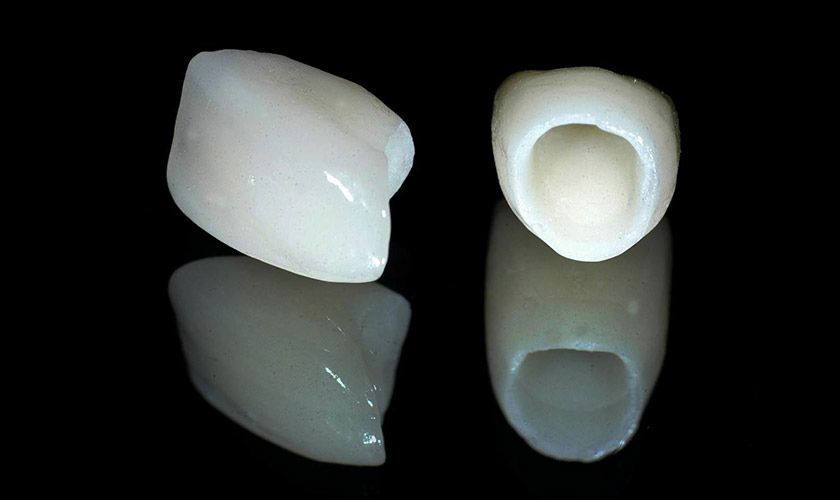 Răng sứ toàn sứ Răng sứ toàn sứ