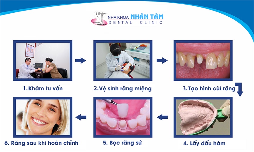 Quá trình bọc răng sứ tại Nha khoa Nhân Tâm