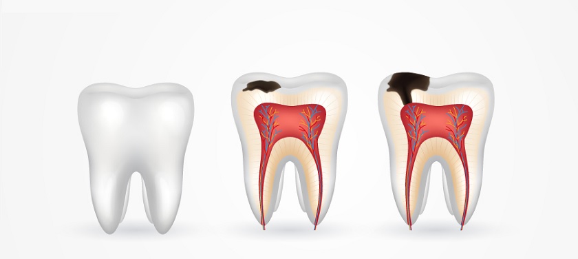 Niềng răng với răng sứ bọc toàn hàm thường có những vấn đề tiềm ẩn