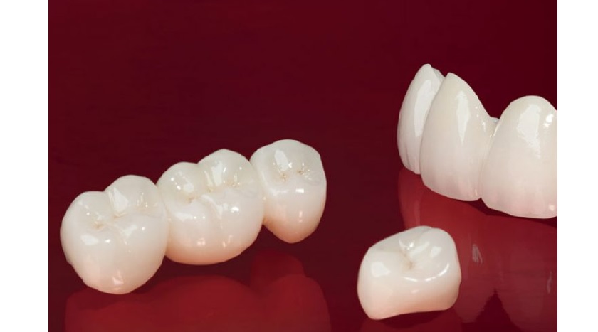 Dán sứ Veneer giúp bảo tồn răng thật