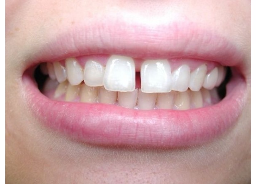 Những trường hợp phù hợp với phương pháp bọc sứ không mài răng?