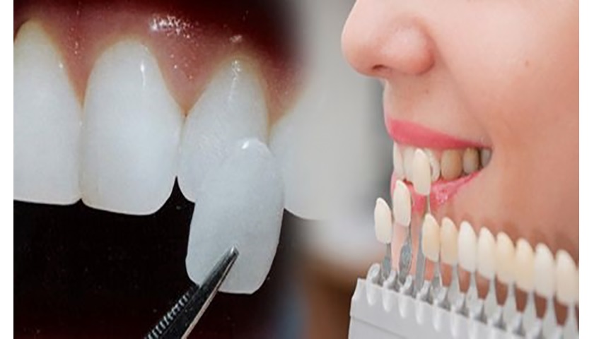Răng sứ Veneer siêu mỏng nên có thể ánh được màu răng thật ra ngoài
