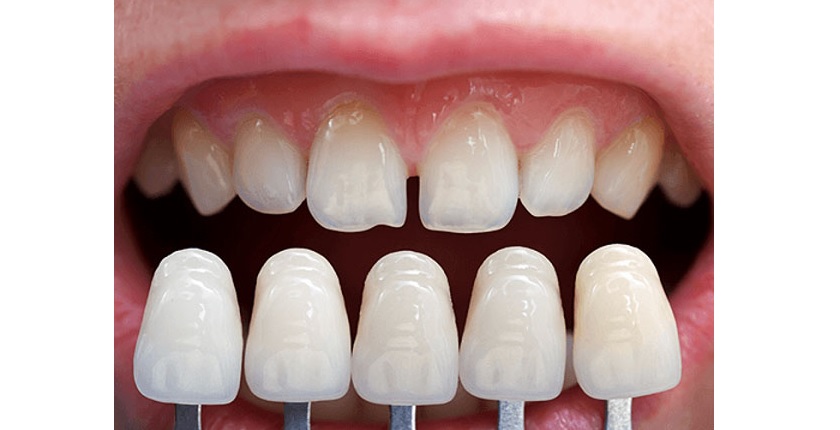 Quy trình dán sứ Veneer