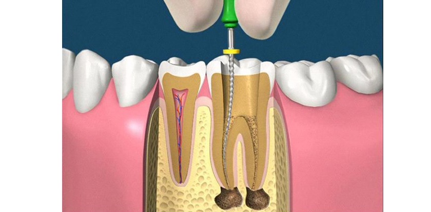 Điều trị tuỷ răng