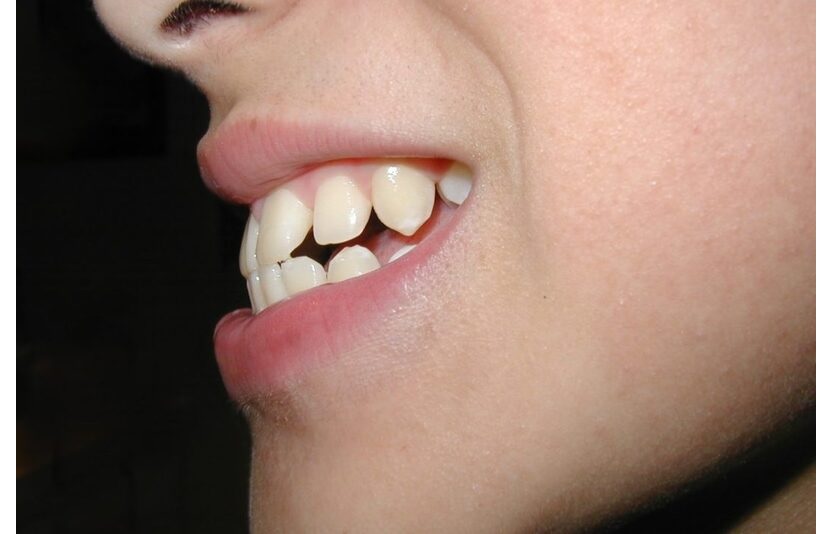 Bọc răng sứ lấy tuỷ răng trong trường hợp răng bị hô, lệch nặng