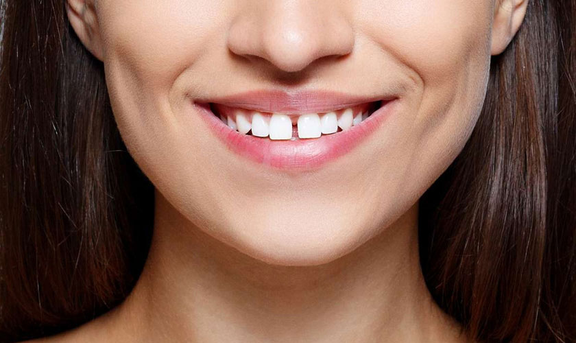 Trường hợp răng thưa không thể hàn trám được thì bọc sứ sẽ là lựa chọn tối ưu