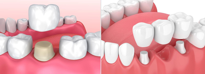 Mão răng sứ và Cầu răng sứ