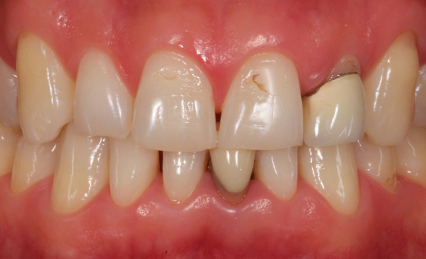 Bọc răng sứ có thể dẫn đến một số biến chứng nguy hiểm