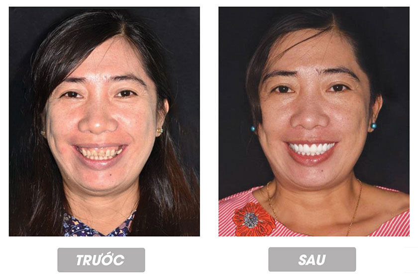 Bọc răng sứ mang lại một hàm răng đều đẹp, trắng sáng tự nhiên như răng thật