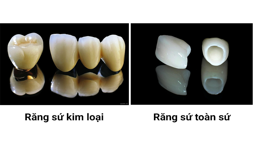 Răng sứ toàn sứ thường có tuổi thọ cao hơn so với răng sứ kim loại