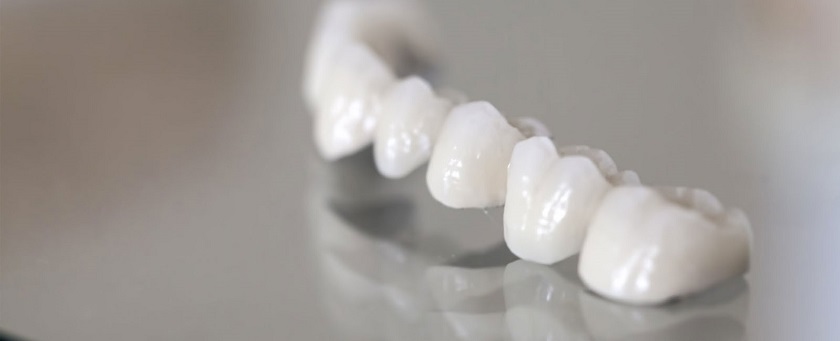 Răng sứ Titanium