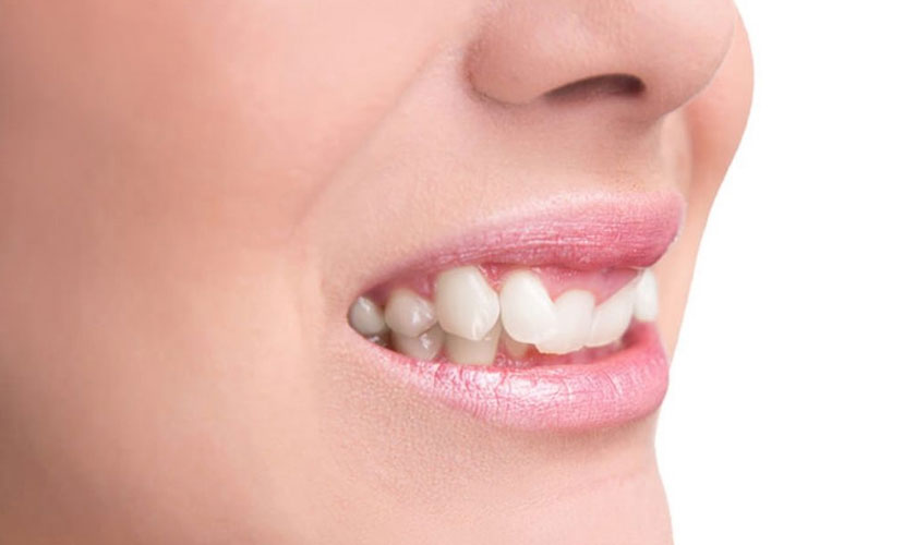 Răng hô nếu làm răng sứ giá bao nhiêu? Có hết hô không?