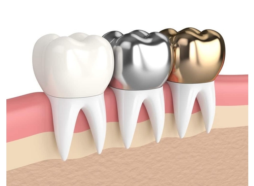 Mão răng sứ cần được gắn khít với chân răng